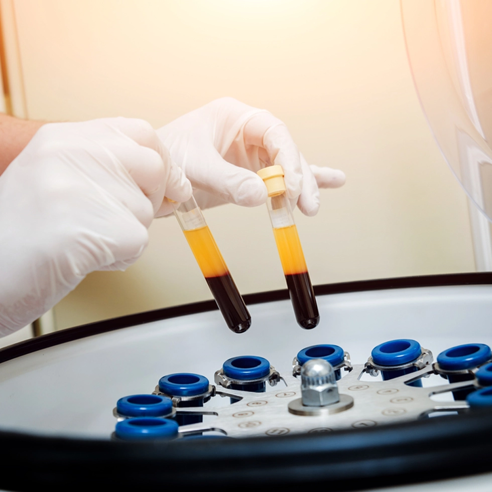 PRP and VSEL (Very Small Embryonic-Like stem cells) test tubes in a centrifuge at BionwoRx: Center for Functional and Regenerative Medicine in Carmel, Indiana, preparing VSELs for Plasma Photobiomodulation Therapy.