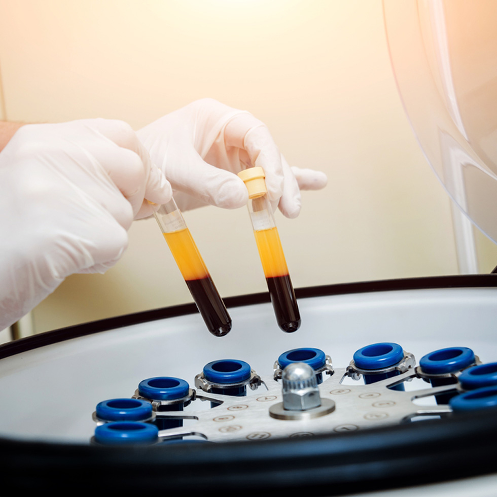 PRP Injection – PRP Tubes – Centrifuge Platelet-rich plasma being separated from whole blood in a centrifuge for regenerative medicine treatment at BionwoRx.