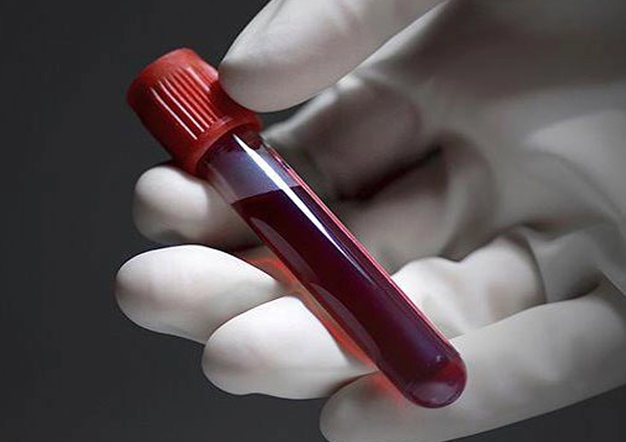 Vial of Blood for PRP and VSEL Therapy at BionwoRx A vial of blood being prepared for platelet-rich plasma (PRP) and VSEL (Very Small Embryonic-Like Stem Cell) therapy at BionwoRx in Carmel, Indiana.
