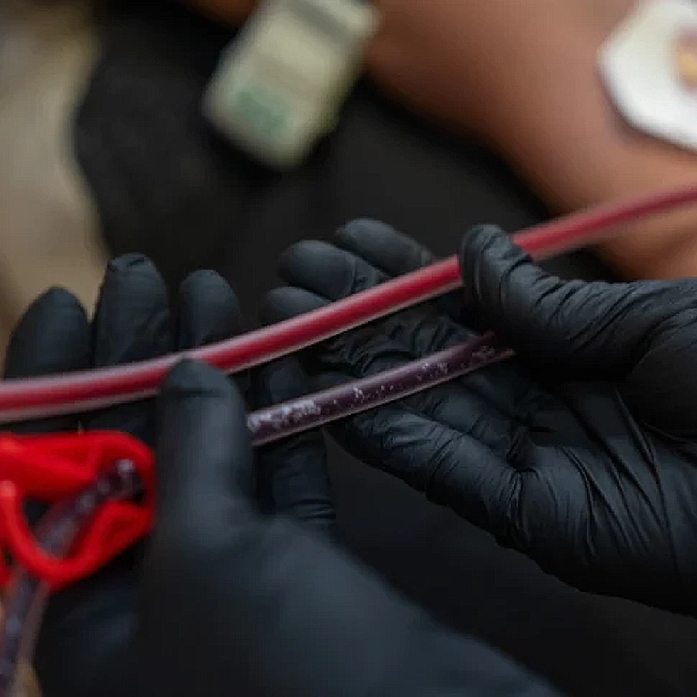 Clean vs Unfiltered Blood During EBO2 Ozone Therapy – BionwoRx Carmel IN Comparison of bright, oxygen-rich cleansed blood and darker unfiltered blood during EBO2 Ozone Therapy at BionwoRx in Carmel, Indiana