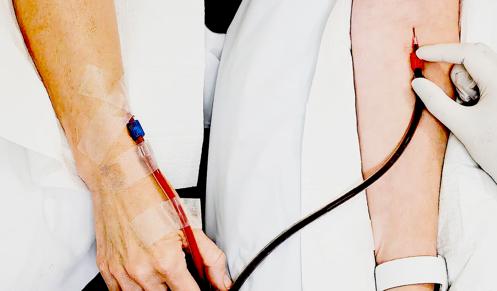 Man receiving Ozone Dialysis (EBO2 Therapy) at BionwoRx, Carmel Indiana Man receiving Ozone Dialysis (EBO2 Therapy) at BionwoRx: Center for Functional and Regenerative Medicine in Carmel, Indiana for anti-aging and cellular health.