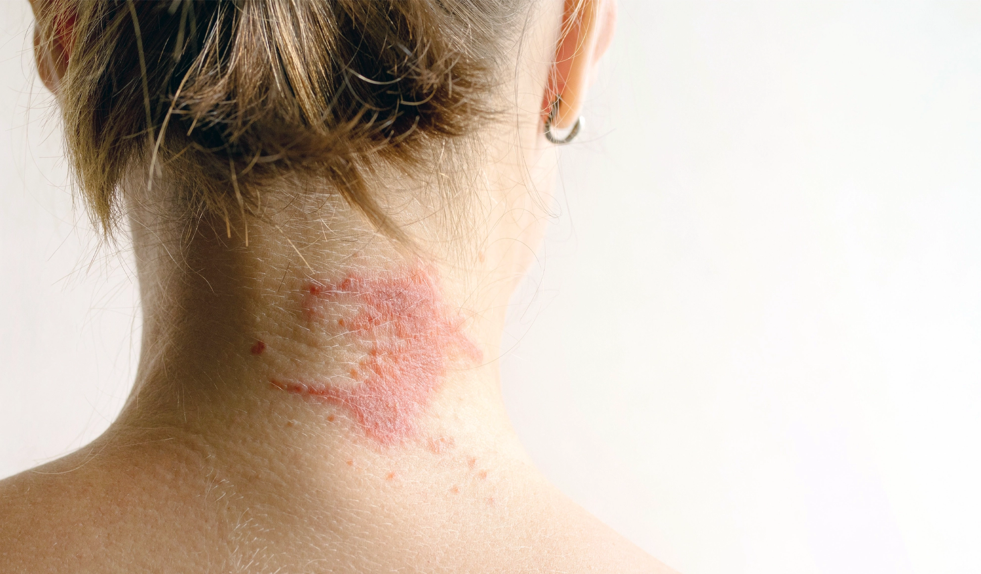 Autoimmune dysfunction eczema neck inflammation ebo2 therapy carmel indiana Back of a woman’s neck showing eczema and skin inflammation associated with autoimmune dysfunction, used to illustrate autoimmune disease care at BionwoRx in Carmel, Indiana
