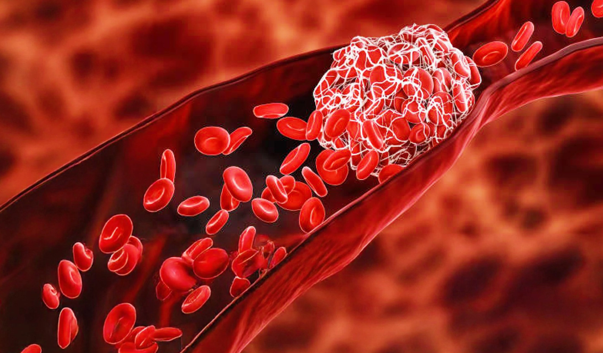 Blood clot formed in EBO2 extracorporeal circuit due to inadequate anticoagulation during therapy